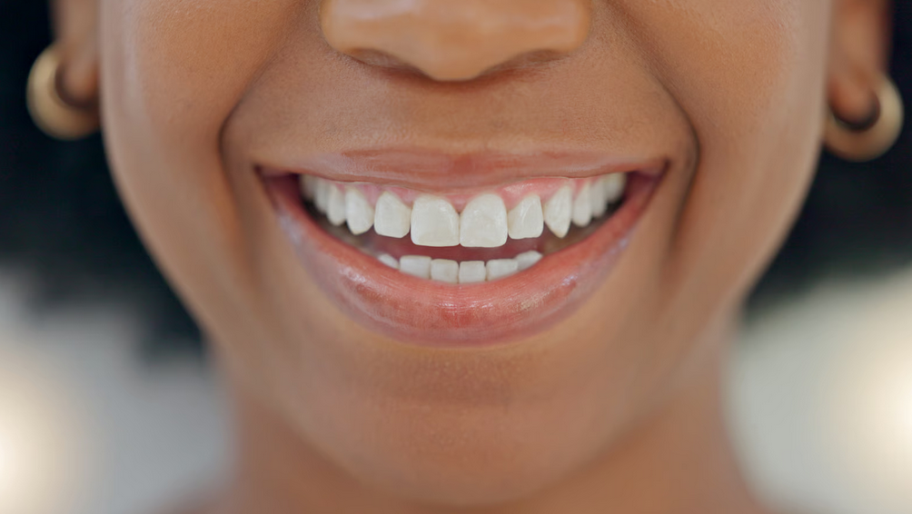 Dental Work in Ghana (2026) – Costs, Clinics, Insurance, Safety